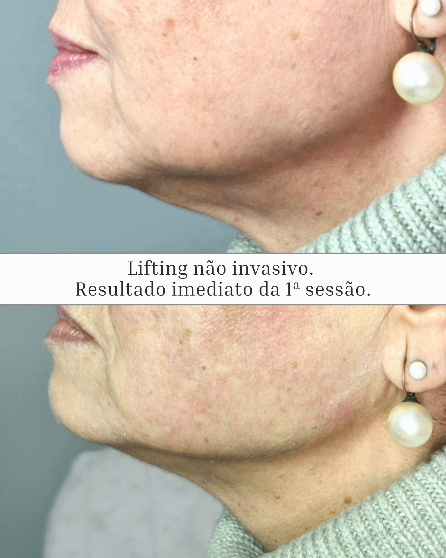 Lifting Facial