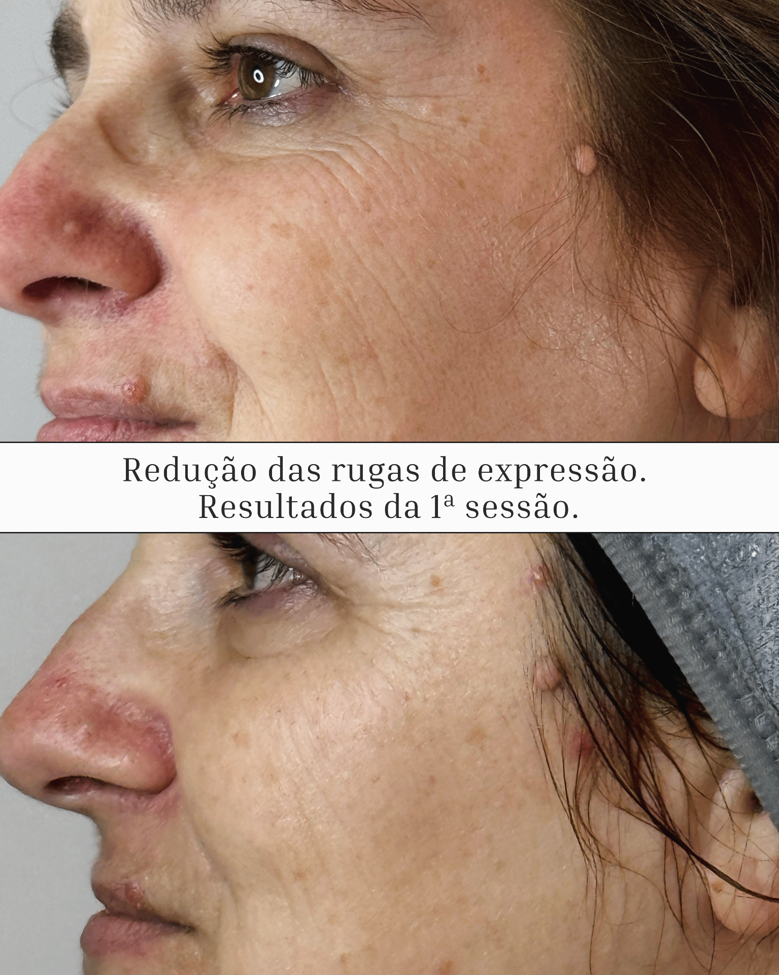 Rugas de Expressão